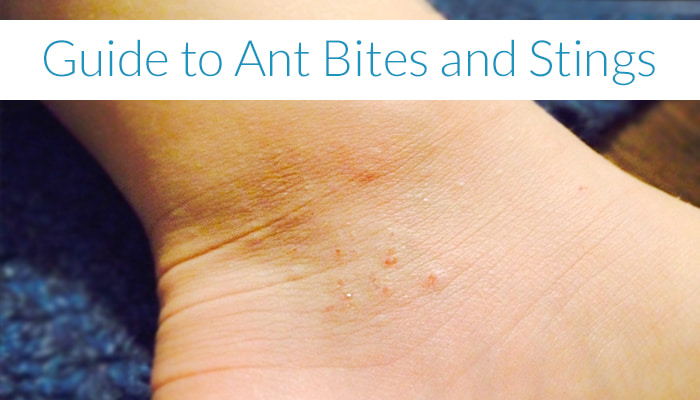 Your Guide To Ant Bites And Stings   Ant Bites Min 